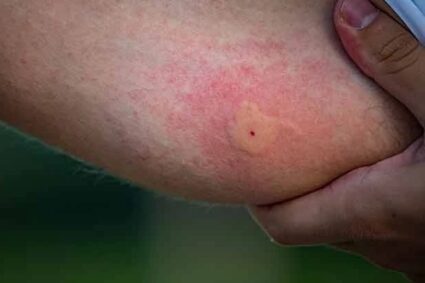 Cúm mùa gia tăng, dịch sốt xuất huyết vào cao điểm