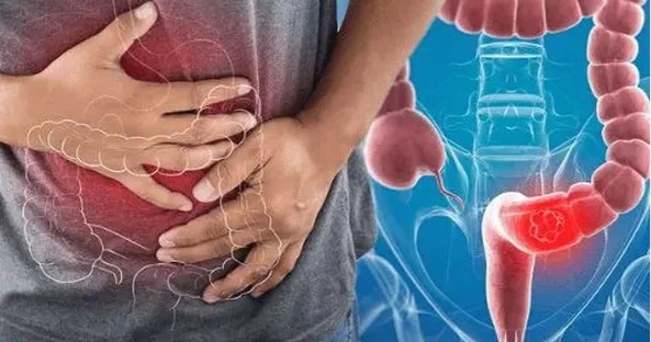 ung-thu-dai-trang-1-17624010442271818177566