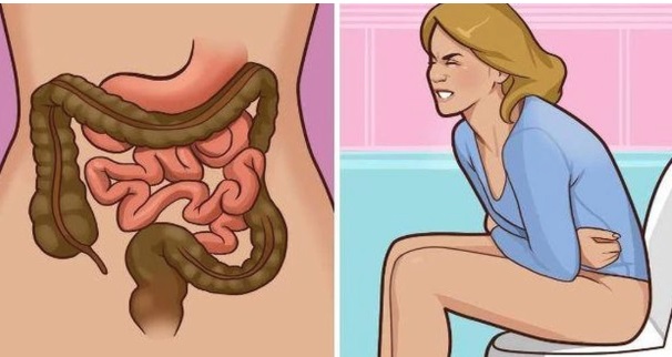 ung-thu-dai-trang-1762401090364385182811