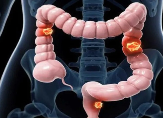 ung-thu-dai-trang-5-17624010645332093614967